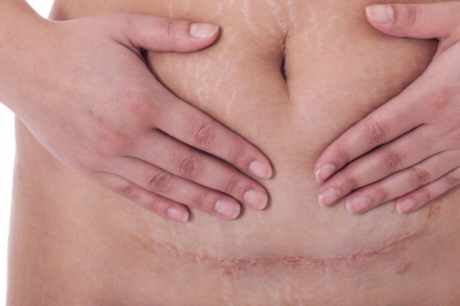 Hasta en las cesáreas