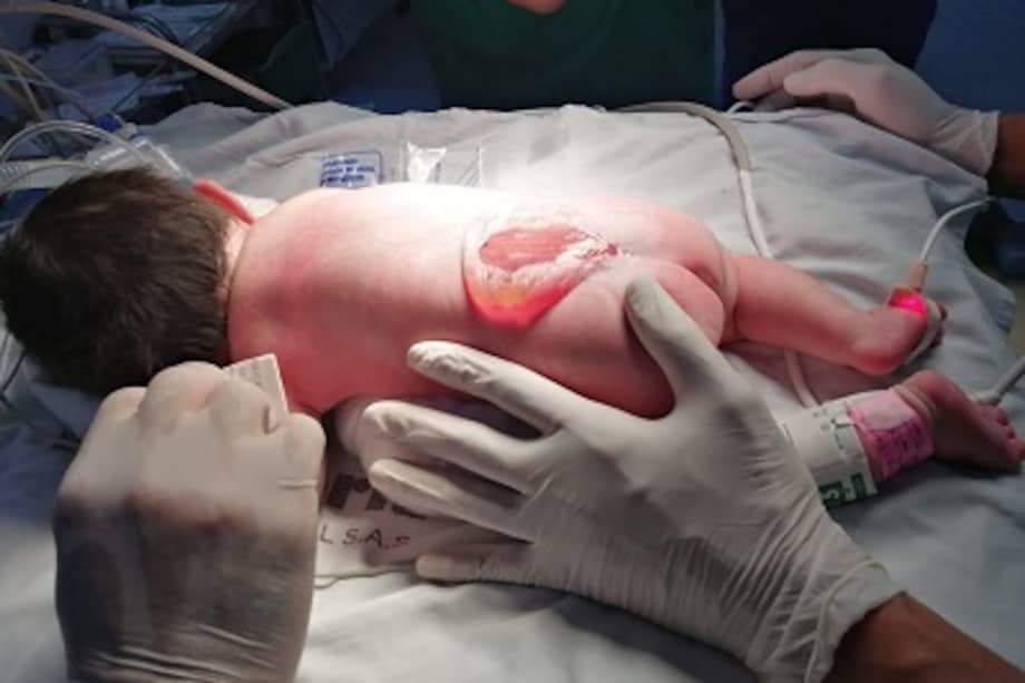 La malformación que presentaba la recién nacida ocurre, en promedio, en uno de cada 1.000 nacimientos.