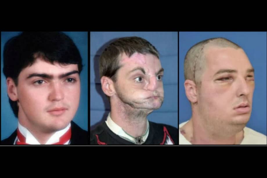 De izquierda a derecha, Joshua Aversano (donante) y Richard Norris antes y después del trasplante de rostro. / AFP
