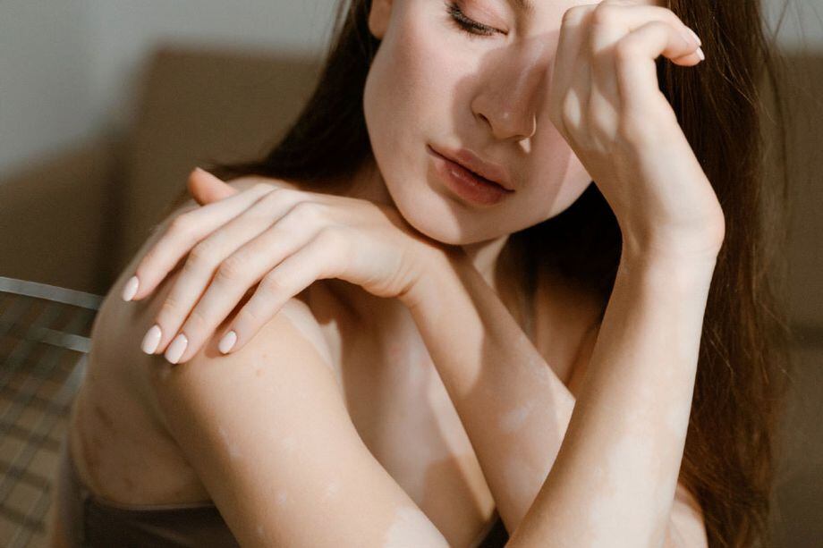 El vitíligo: la enfermedad de las manchas blancas en la piel