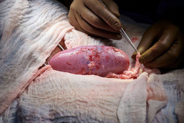 Por primera vez trasplantan con éxito riñón de cerdo a mujer en muerte cerebral