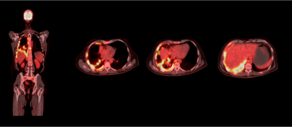 Atlas fotográfico oncológico PET/CT 18F-FDG.