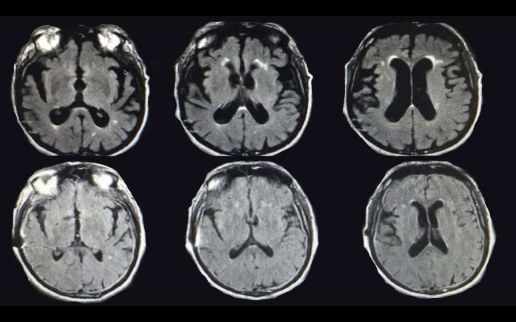 La Hidrocefalia con Presión Normal puede causar síntomas similares a los del Alzheimer y otras demencias, pero es tratable.