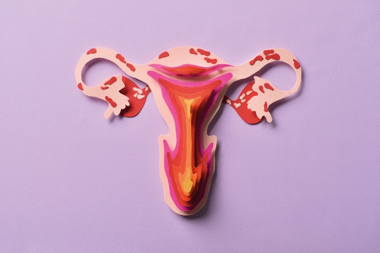 Endometriosis: abrazar el dolor