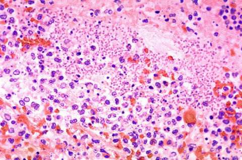 Una de cada siete muertes en niños es causada por la neumonía y otras infecciones respiratorias