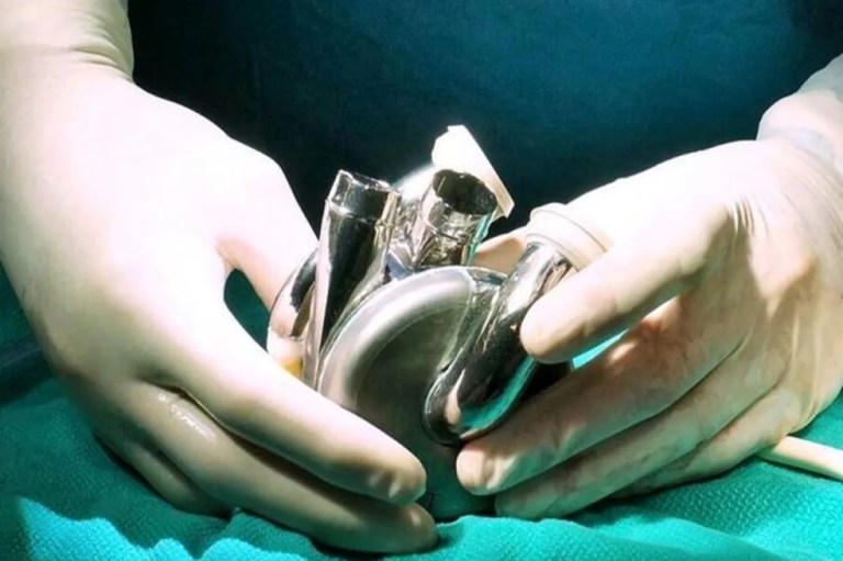 Por primera vez trasplantan un corazón de titanio a una persona