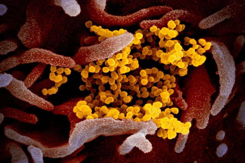 Esta imagen de microscopio electrónico de barrido muestra el coronavirus (amarillo) entre las células humanas (rosa). / RML