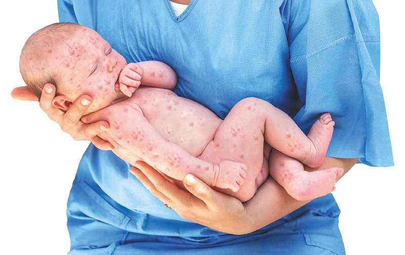 El sarampión es la quinta enfermedad erradicada en América gracias a las vacunas y jornadas de prevención. / iStock