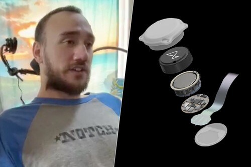 Implante de Neuralink: el testimonio del primer paciente que recibió el chip
