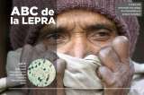 Todo lo que debe saber de la lepra