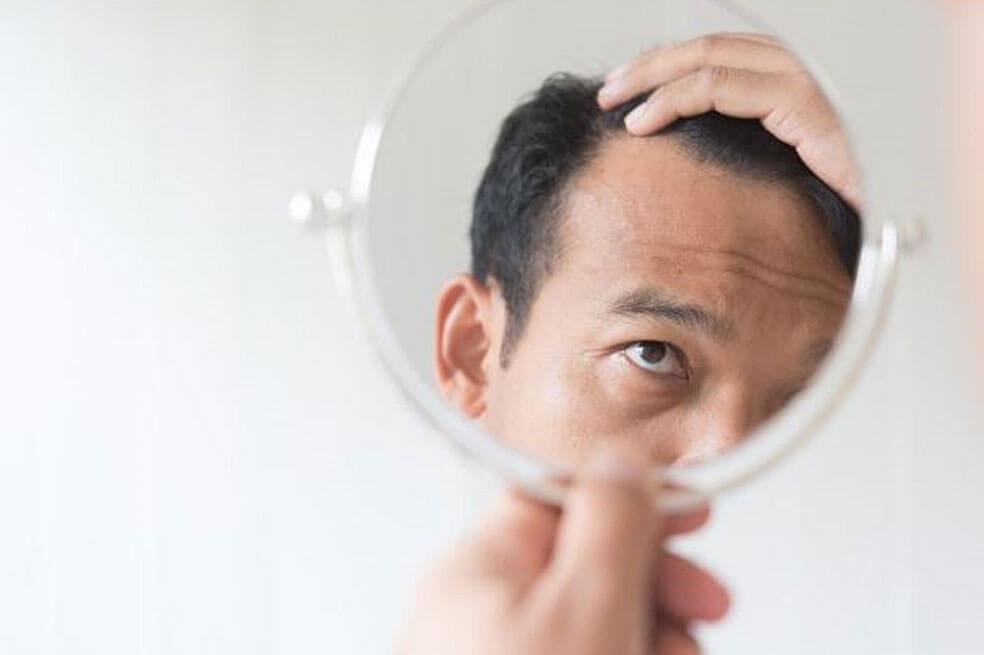 Consejos para prevenir la alopecia