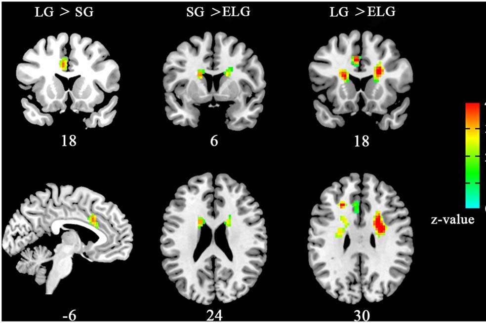 Así se ven las resonancias que tomaron los científicos, donde se muestran las áreas cerebrales que podrían estar involucradas con el amor. / www.frontiersin.org