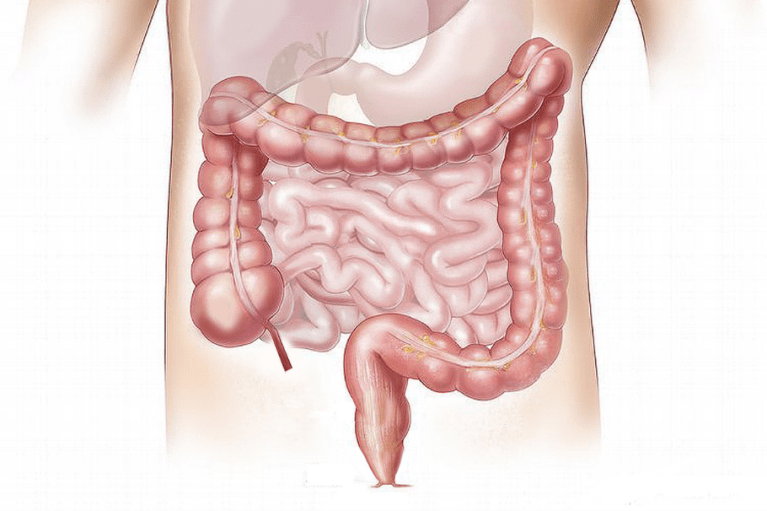 Cáncer de colon: un “enemigo silencioso” que va en aumento, ¿cómo prevenirlo?