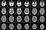 Optimismo por células madre en tratamiento de enfermedad cerebrovascular