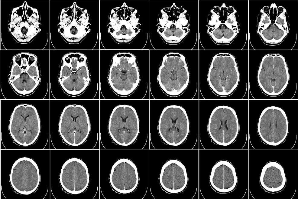 Imagen de un cerebro con tomografía computarizada. / Pixabay