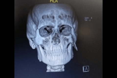 Médicos salvan de la muerte a hombre con pulidora incrustada en su rostro en Bogotá