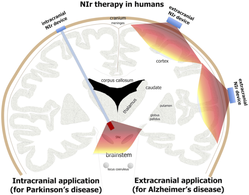 El gráfico muestra la estimulación con rayos infrarrojos directamente sobre una zona del cerebro a través de un implante (izquierda) para el Parkinson o desde la zona exterior para el Alzheimer.