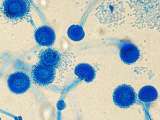 Las infecciones por hongos también tuvieron un papel en la pandemia del covid-19