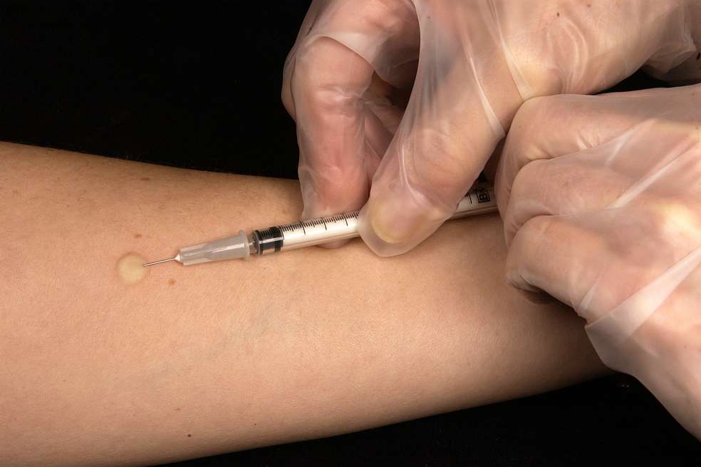 2004
Gabrielle Benenson
<b>This technician is in the process of correctly placing a Mantoux tuberculin skin test in this recipient’s forearm, which will cause a 6mm to10mm wheal, i.e., a raised area of skin surface, to form at the injection site.</b><p>The Mantoux tuberculin skin test is used to evaluate people for latent tuberculosis (TB) infection. In the United States, this skin test consists of an intradermal injection of exactly one tenth of a milliliter (mL) of tuberculin, which contains 5 tuberculin units. Correct placement of this intradermal injection involves inserting the needle bevel slowly at a 5° to 15° angle. The needle bevel is advanced through the epidermis, the superficial layer of skin, approximately 3mm so that the entire bevel is covered and lies just under the skin. A tense, pale wheal that is 6 to 10mm in diameter appears over the needle bevel.