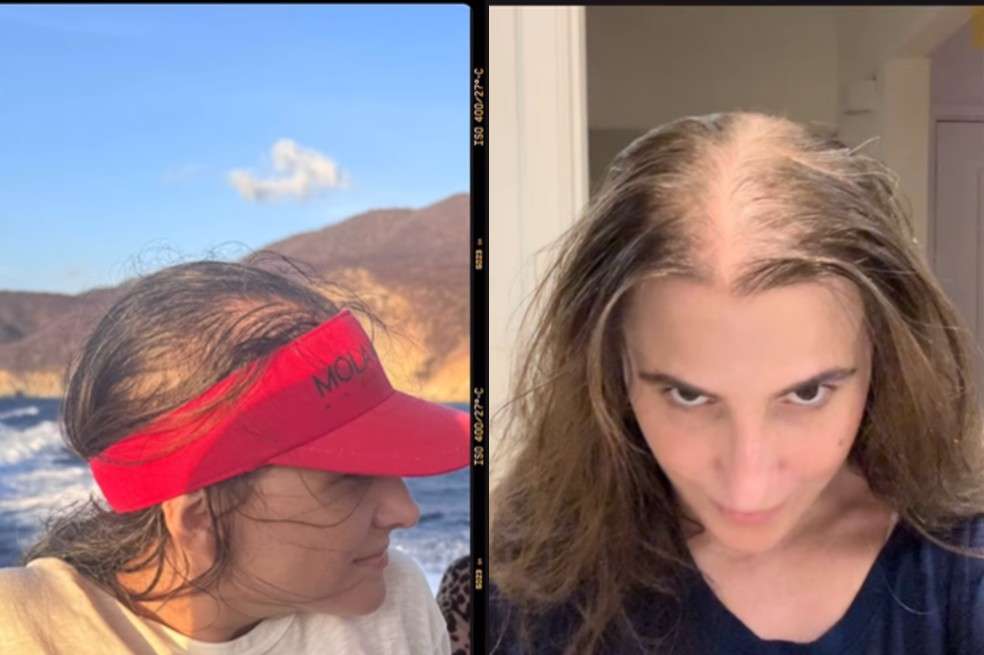 Marcela García mostró su alopecia.