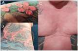 El caso del hombre al que un tatuaje con tinta roja le provocó vitíligo y caída de cabello