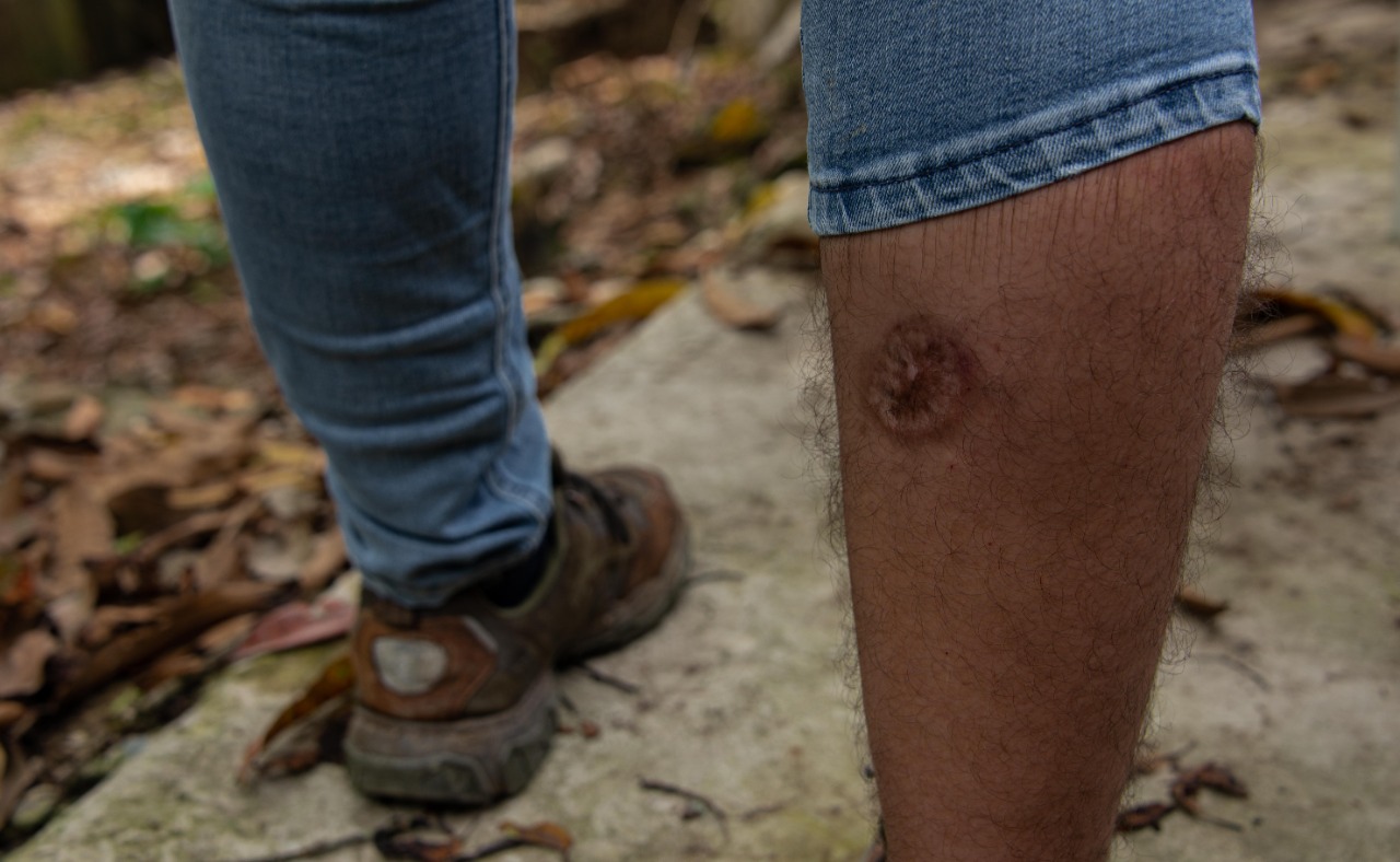 El cráter en la piel, de algo más de una pulgada, recuerda la boca de un volcán. Es la herida que deja en la piel la leishmaniasis. / Ignacio Galán