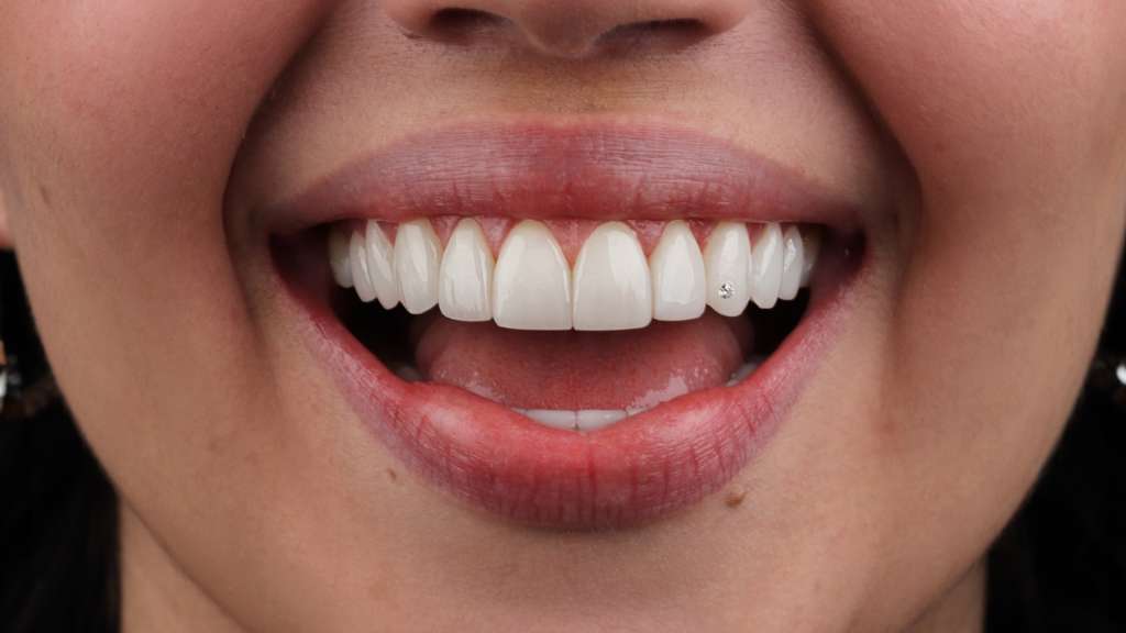 sonrisas con diamantes