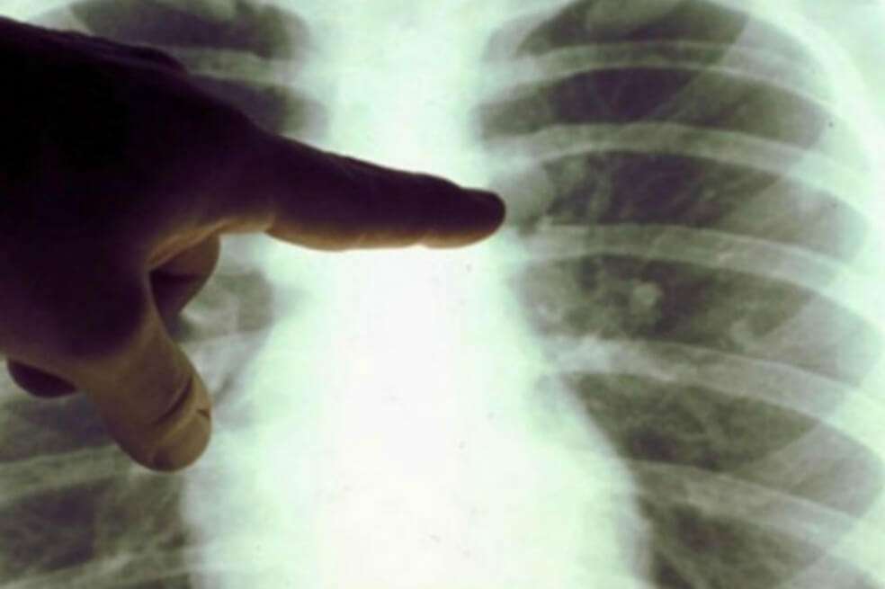 Según el estudio, la inteligencia artificial podría aumentar la detección de cáncer en un 5%.  / Archivo EFE