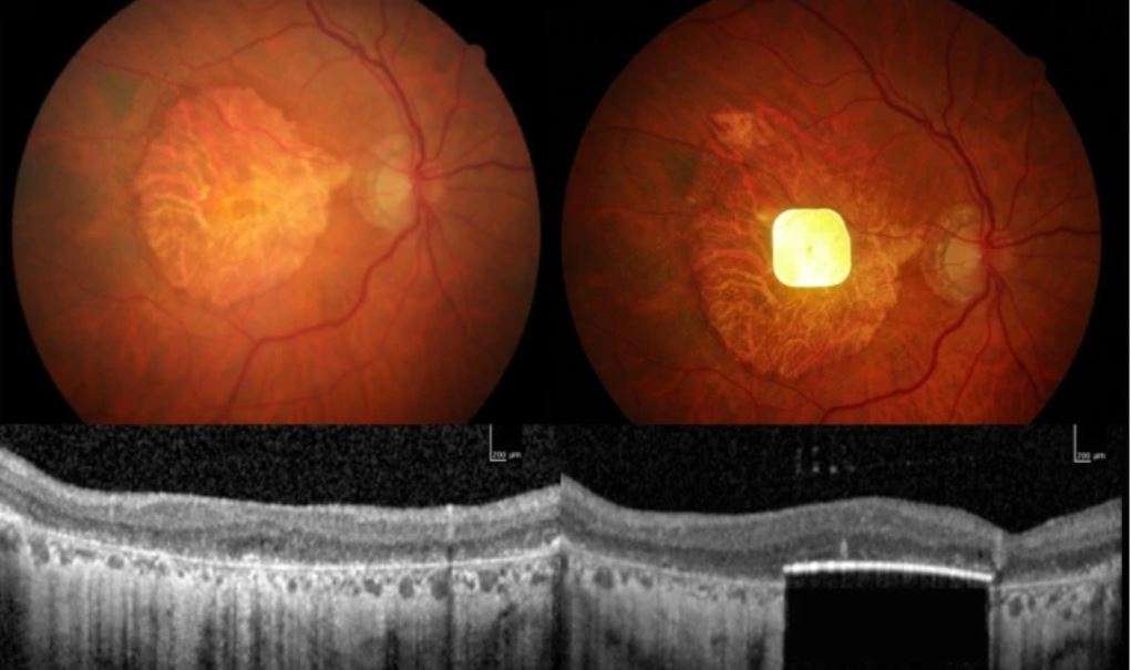 Un dispositivo eléctrico implantado bajo la retina ayuda a restaurar la agudeza visual en personas con degeneración macular asociada a la edad. Crédito: Science Corporation
