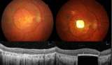 Un pequeño microimplante de retina da esperanza a personas que han perdido la vista