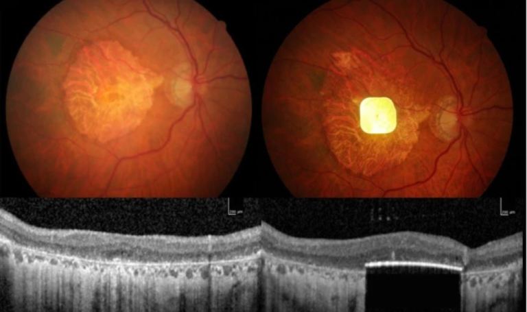 Un pequeño microimplante de retina da esperanza a personas que han perdido la vista