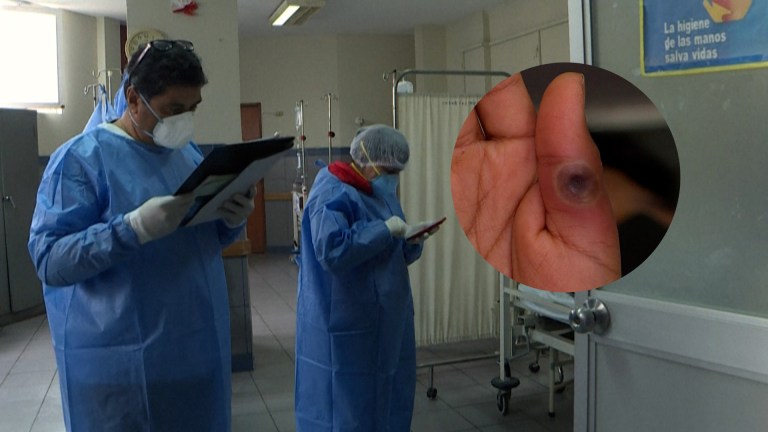 Viruela símica: esto es lo que debe saber de la emergencia de salud pública