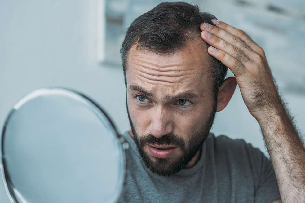 Alopecia en hombres y mujeres