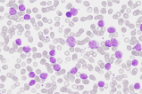 Por primera vez detallan cambios genéticos generados por leucemia linfática crónica