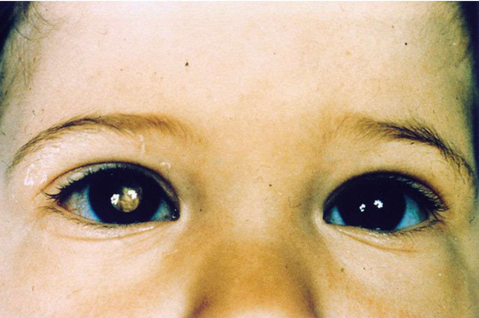Niño con retinoblastoma. / Wikicommons