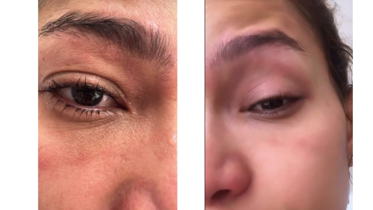 La exreina Andrea Tovar sufrió accidente con aceite caliente: le afectó una cornea