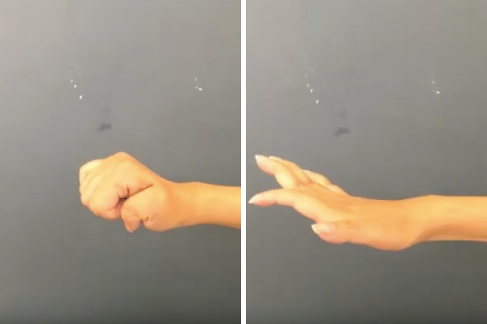 Gracias a una innovadora cirugía que "reconecta" los nervios, 13 tetrapléjicos recuperan la movilidad de sus manos y codos, pudiendo comer y escribir por sí mismos. / Captura de pantalla video The Lancet