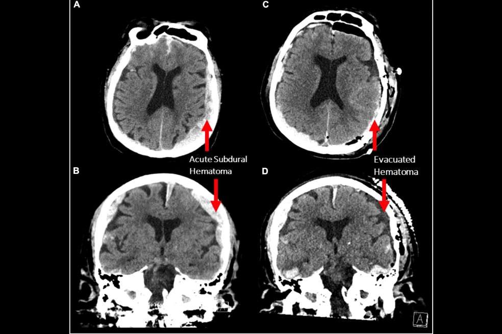 Científicos registraron la actividad cerebral de un paciente de 87 años mientras moría.