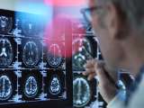 ¿Cómo identificar un posible cáncer cerebral? Síntomas, diagnóstico y tratamientos actuales