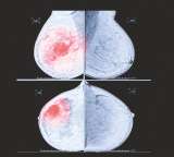 Así rastrean la herencia del cáncer de seno en las latinas