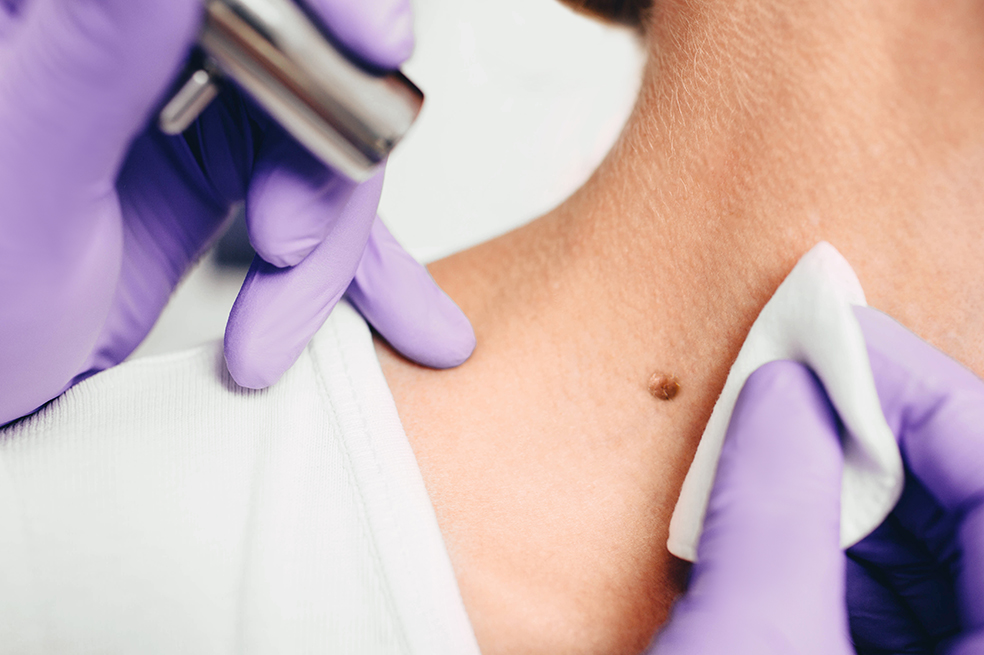 Imagen de referencia. Una de las recomendaciones para quienes tienen prescrito el uso de hidroclorotiazida es realizarse autoexámenes regulares (cada mes) para observar cambios en la piel y consultar inmediatamente a un médico o dermatólogo si se identifica algo inusual.