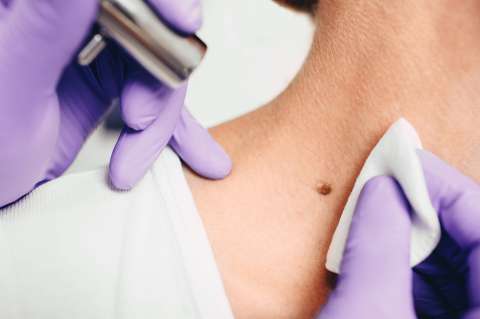 Cómo prevenir el cáncer de piel