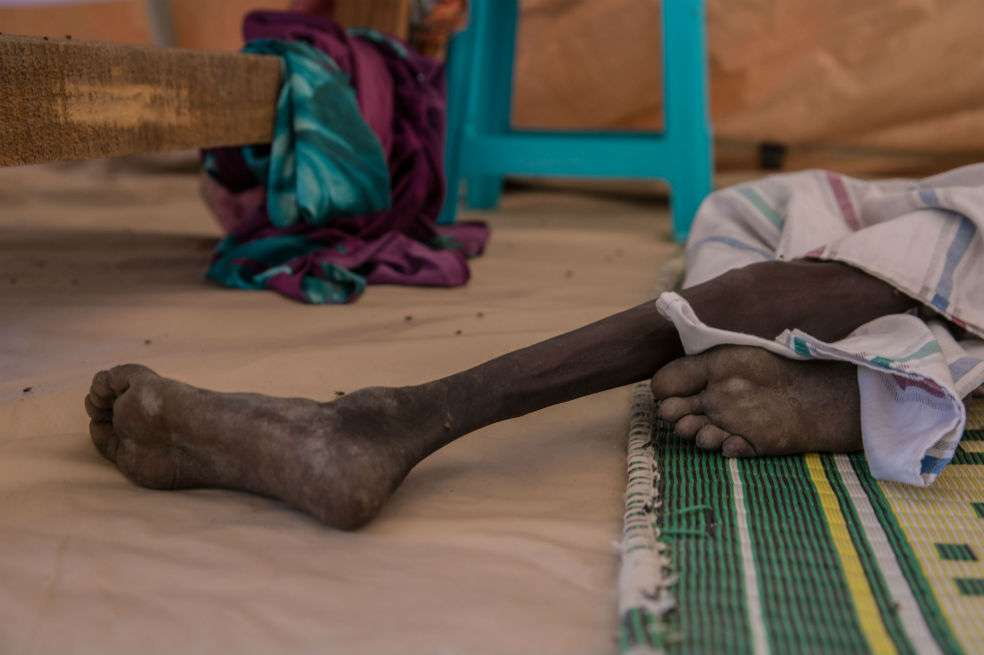 Este es un joven de 18 años con malnutrición en Sudán del Sur, donde el conflicto impidió la llegada de alimentos. / AFP