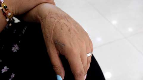 Nueva belleza: un reportaje sobre las agresiones con agentes químicos