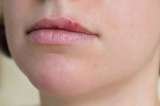 Tengo un herpes labial. ¿Qué hago?