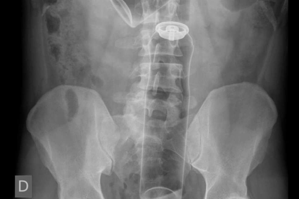 Radiografía de paciente que se introdujo dos botes metálicos de desodorante por el recto. / Semergen - Elsevier Espana