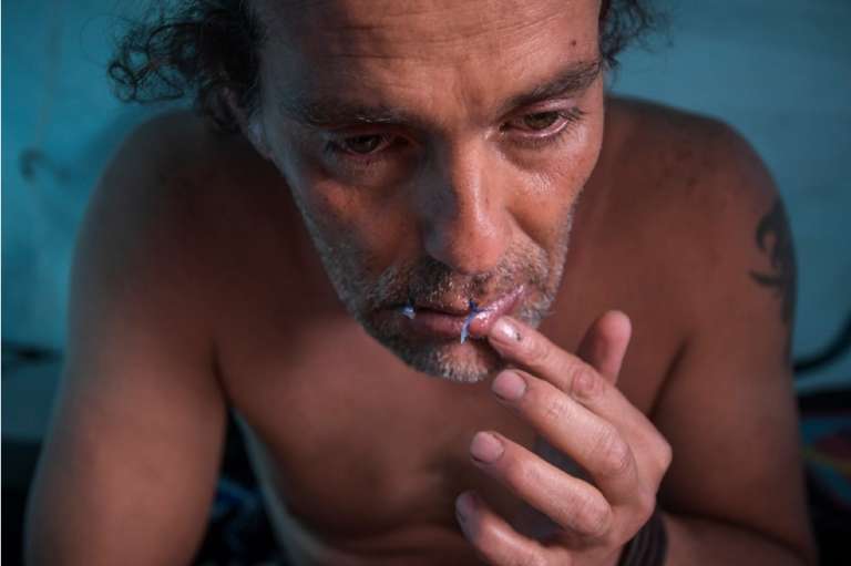 El artista John Fitzgerald tiene la boca cosida con seis puntadas.