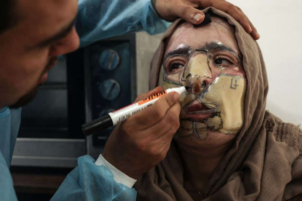 Izdihar al-Amawi sufrió graves quemaduras y el pasado 22 de febrero comenzó a usar una máscara diseñada por Médicos sin Fronteras.