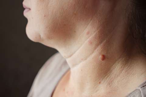 Verrugas en el cuello: ¿por qué aparecen y qué pasa si te las quitas en casa?