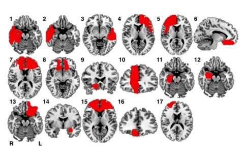 La relación entre las lesiones cerebrales y los crímenes